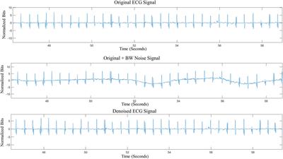 Enhancement of single-lead dry-electrode ECG through wavelet denoising